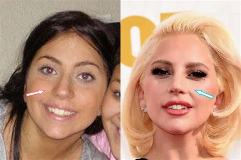 did lady gaga have a nose job